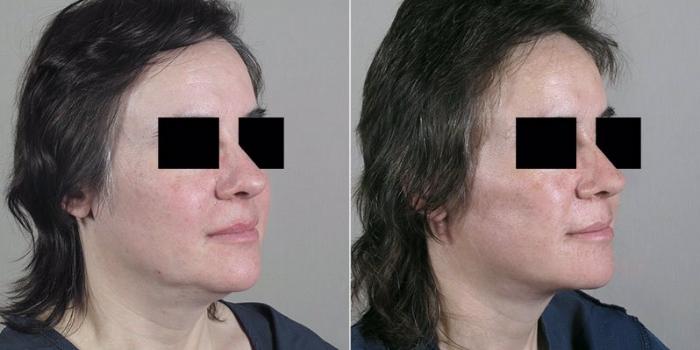 Facelift Case 22 Before & After View #2 | Paramus, New Jersey | Parker Center for Plastic Surgery