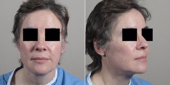 Facelift Case 22 Before & After View #3 | Paramus, New Jersey | Parker Center for Plastic Surgery