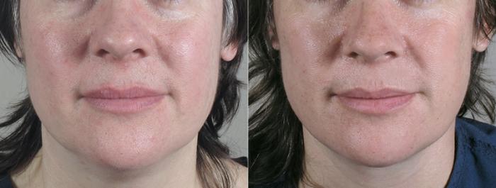 Facelift Case 22 Before & After View #4 | Paramus, New Jersey | Parker Center for Plastic Surgery