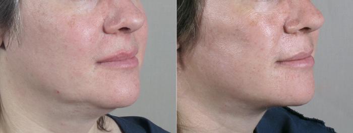 Facelift Case 22 Before & After View #5 | Paramus, New Jersey | Parker Center for Plastic Surgery