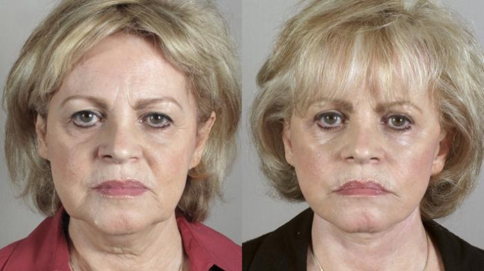 Facelift Case 23 Before & After View #1 | Paramus, New Jersey | Parker Center for Plastic Surgery