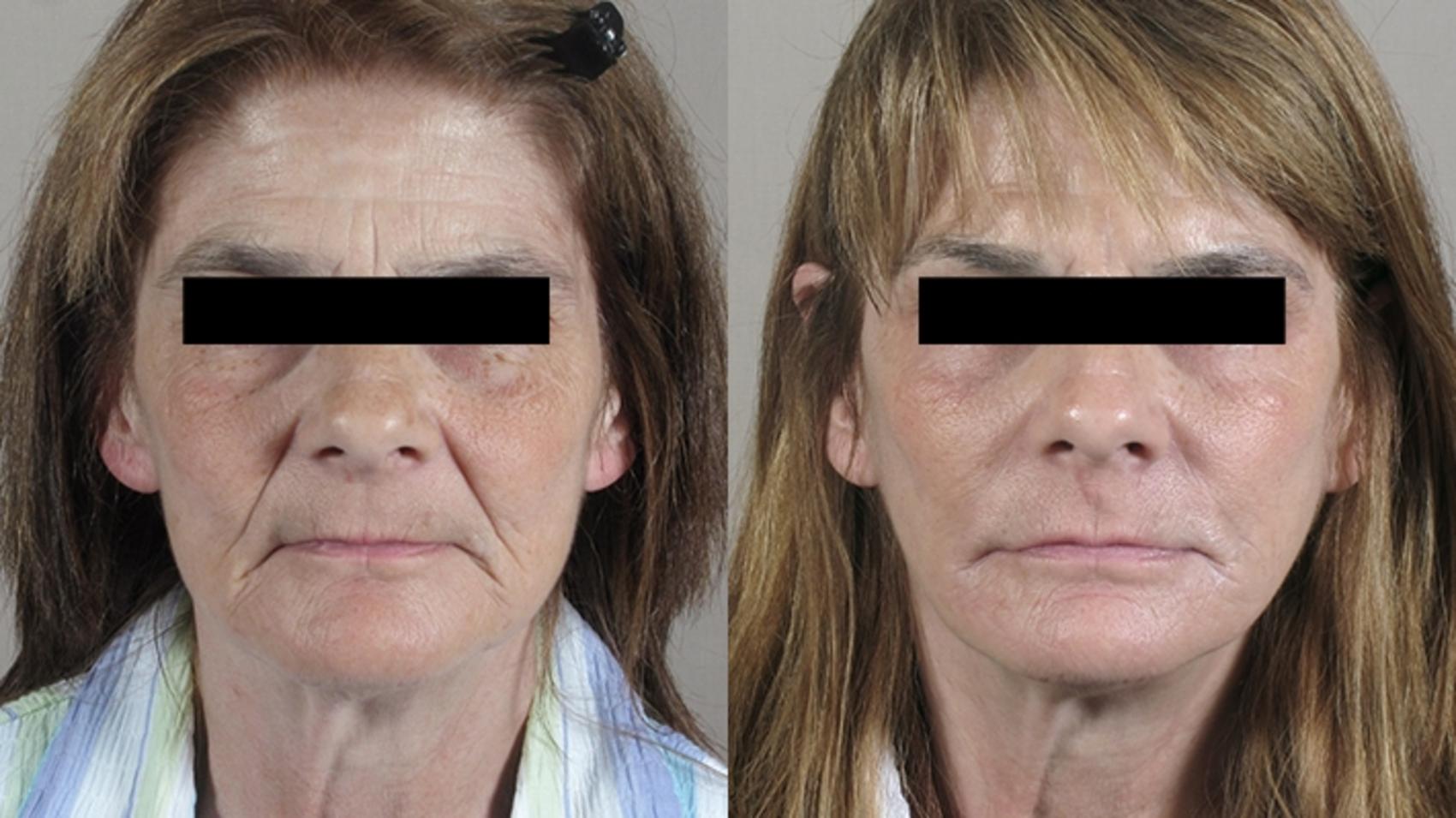 Facelift Case 24 Before & After View #1 | Paramus, New Jersey | Parker Center for Plastic Surgery