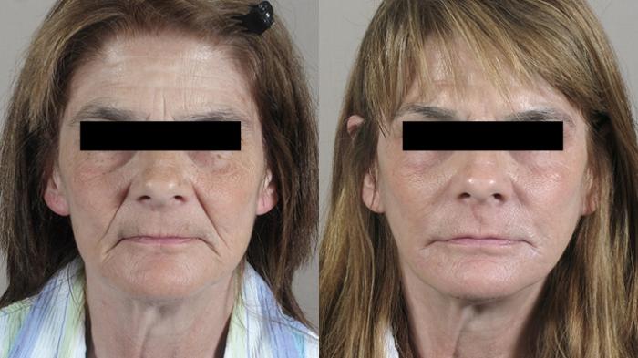 Facelift Case 24 Before & After View #1 | Paramus, New Jersey | Parker Center for Plastic Surgery