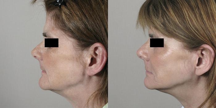 Facelift Case 24 Before & After View #2 | Paramus, New Jersey | Parker Center for Plastic Surgery