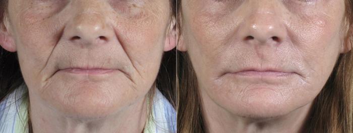 Facelift Case 24 Before & After View #3 | Paramus, New Jersey | Parker Center for Plastic Surgery