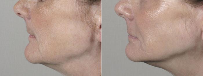Facelift Case 24 Before & After View #4 | Paramus, New Jersey | Parker Center for Plastic Surgery