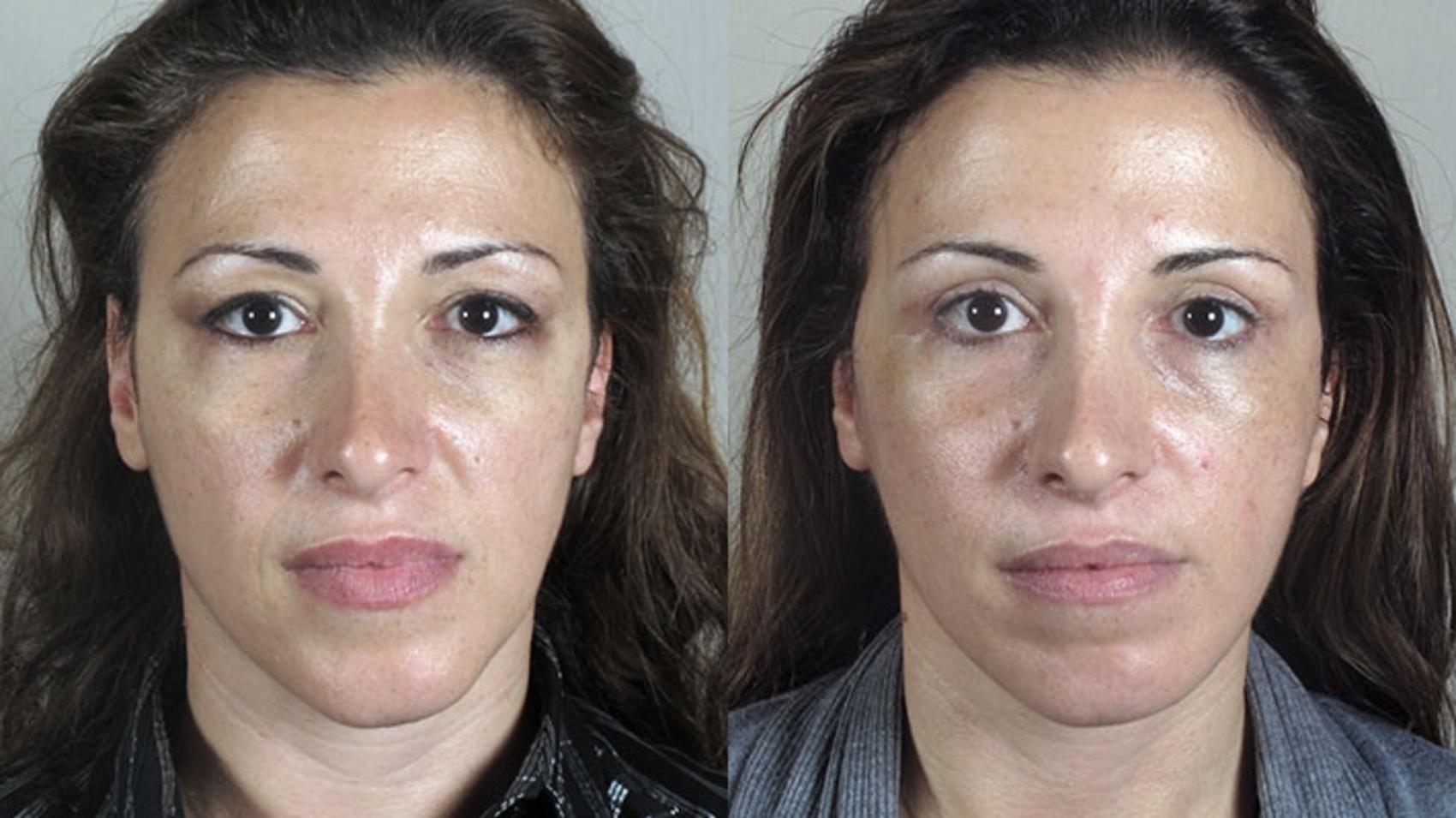 Facelift Case 28 Before & After View #1 | Paramus, New Jersey | Parker Center for Plastic Surgery