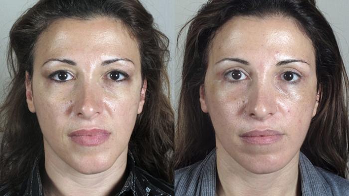 Facelift Case 28 Before & After View #1 | Paramus, New Jersey | Parker Center for Plastic Surgery