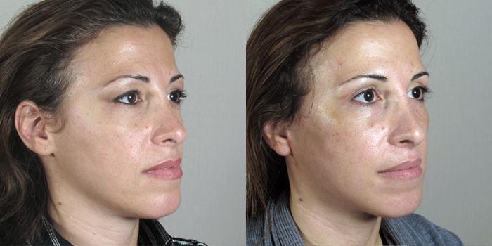 Facelift Case 28 Before & After View #2 | Paramus, New Jersey | Parker Center for Plastic Surgery
