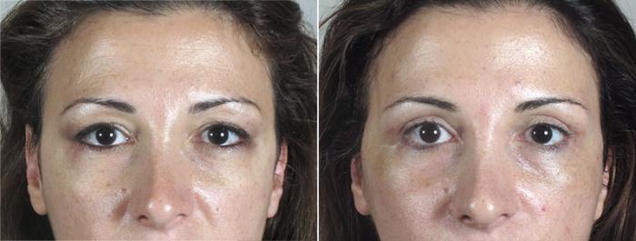Facelift Case 28 Before & After View #3 | Paramus, New Jersey | Parker Center for Plastic Surgery