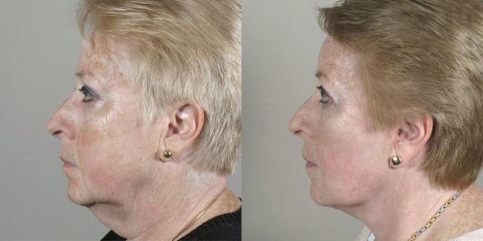 Facelift Case 30 Before & After View #2 | Paramus, New Jersey | Parker Center for Plastic Surgery
