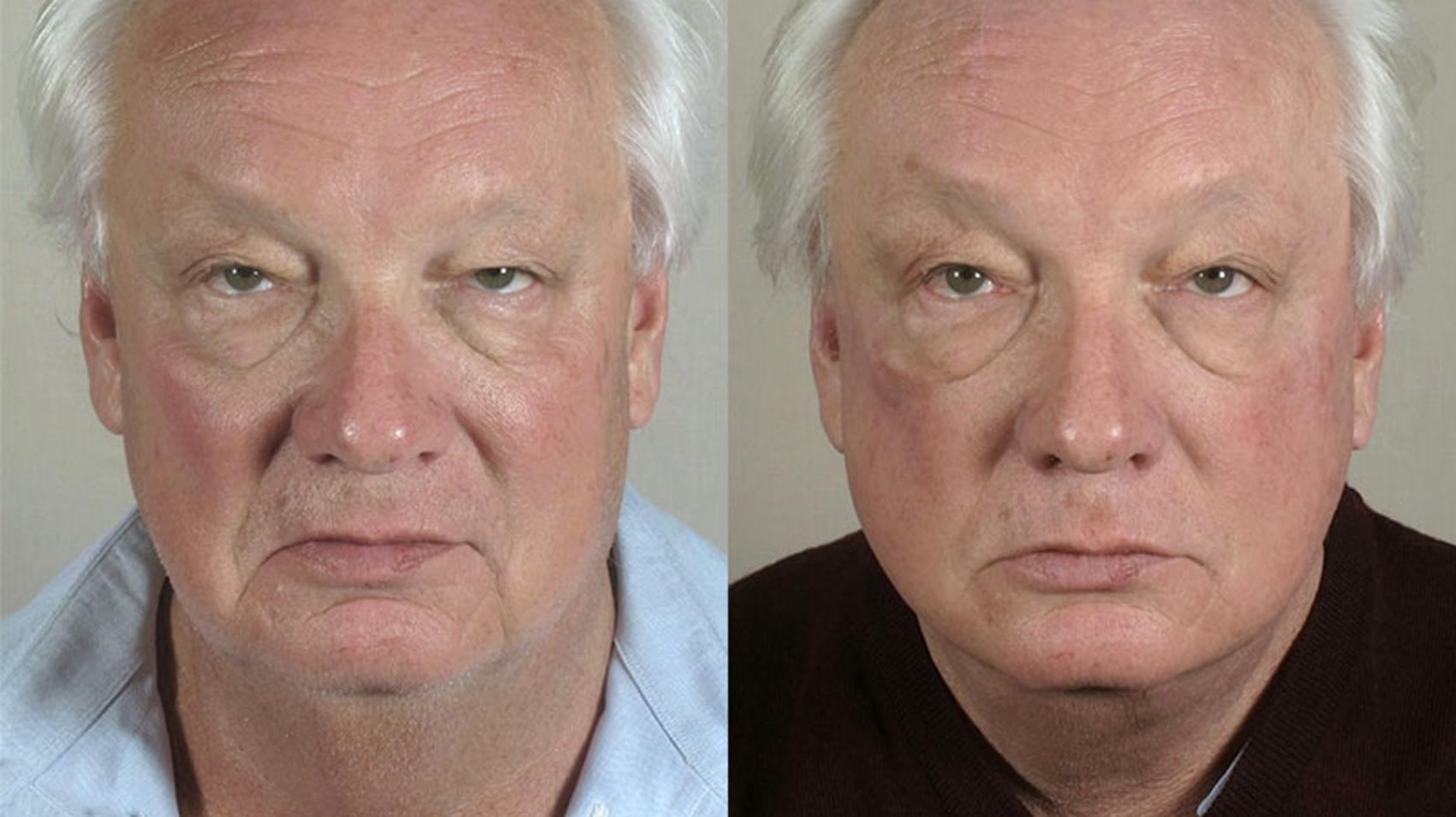 Facelift Case 32 Before & After View #1 | Paramus, New Jersey | Parker Center for Plastic Surgery