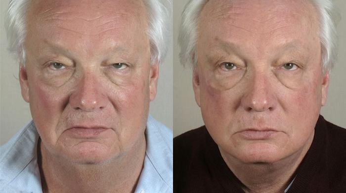 Facelift Case 32 Before & After View #1 | Paramus, New Jersey | Parker Center for Plastic Surgery