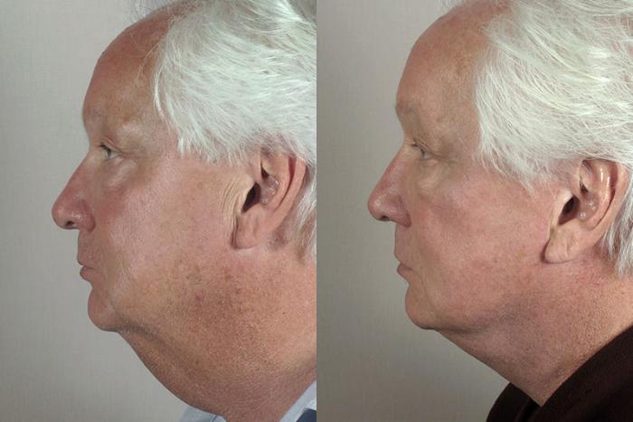 Facelift Case 32 Before & After View #2 | Paramus, New Jersey | Parker Center for Plastic Surgery
