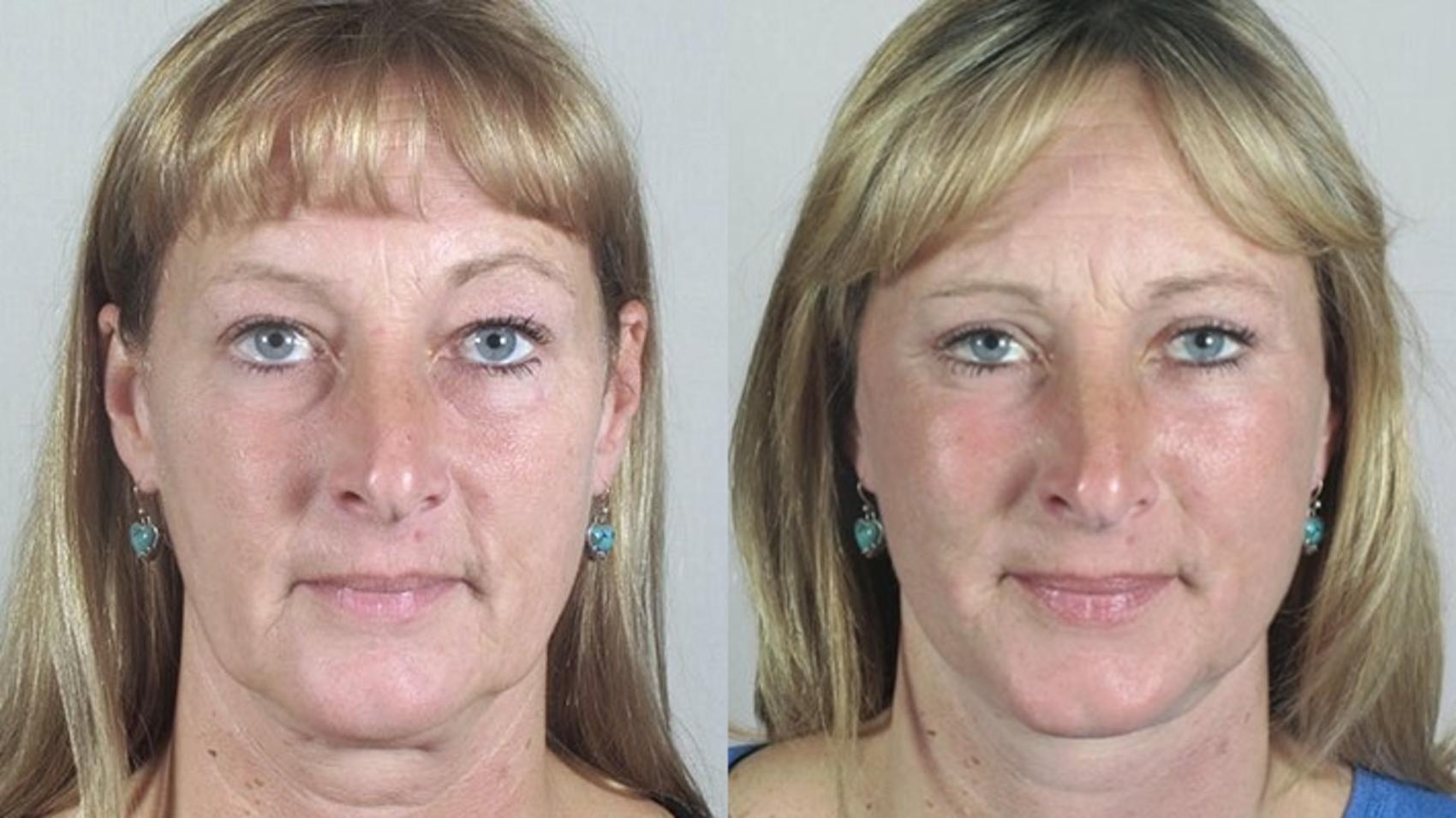 Facelift Case 33 Before & After View #1 | Paramus, New Jersey | Parker Center for Plastic Surgery