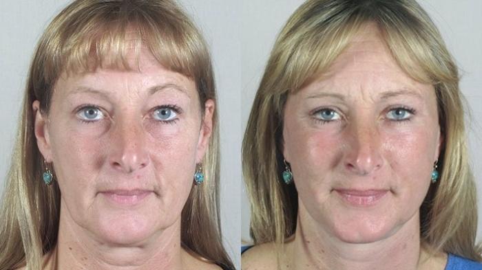 Facelift Case 33 Before & After View #1 | Paramus, New Jersey | Parker Center for Plastic Surgery