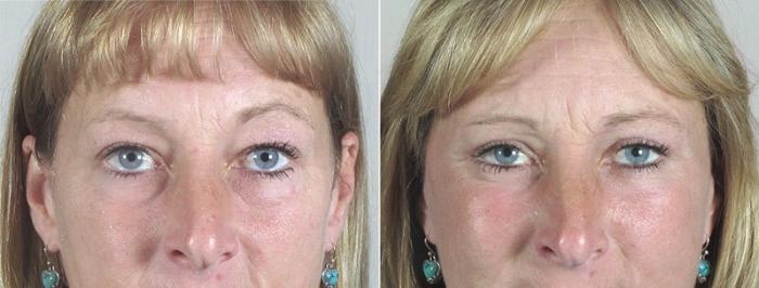 Facelift Case 33 Before & After View #3 | Paramus, New Jersey | Parker Center for Plastic Surgery