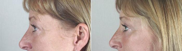 Facelift Case 33 Before & After View #6 | Paramus, New Jersey | Parker Center for Plastic Surgery