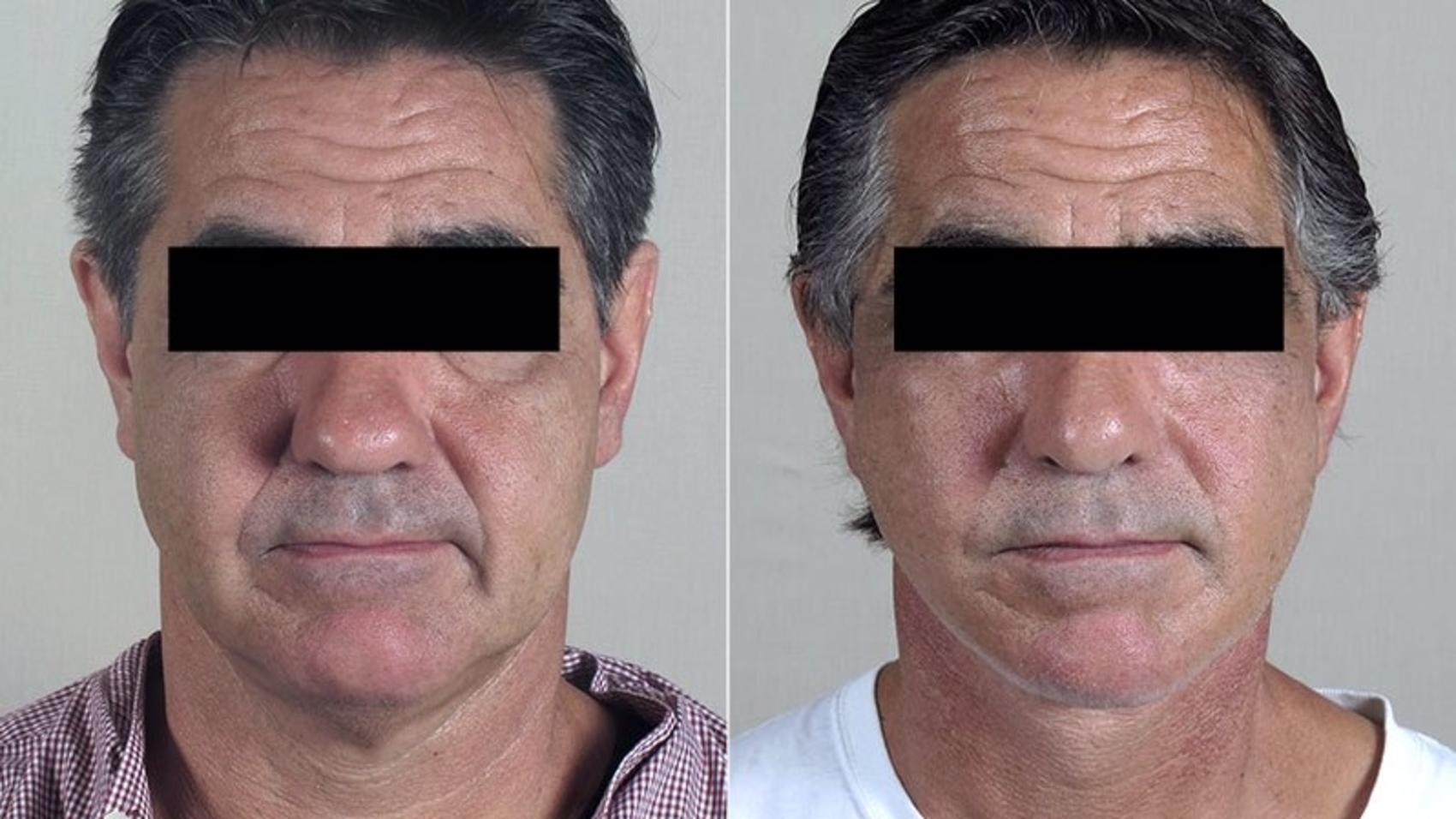 Facelift Case 34 Before & After View #1 | Paramus, New Jersey | Parker Center for Plastic Surgery