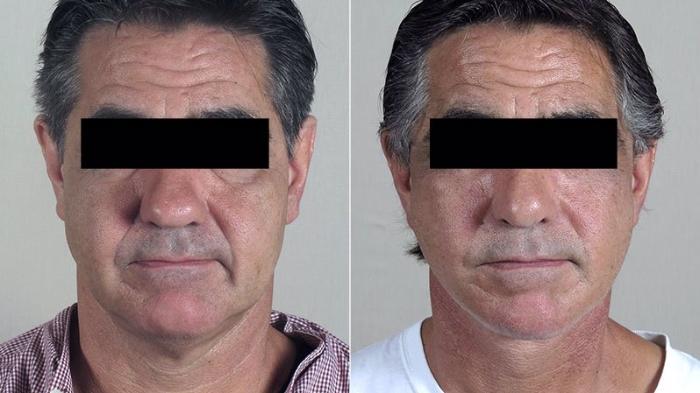 Facelift Case 34 Before & After View #1 | Paramus, New Jersey | Parker Center for Plastic Surgery