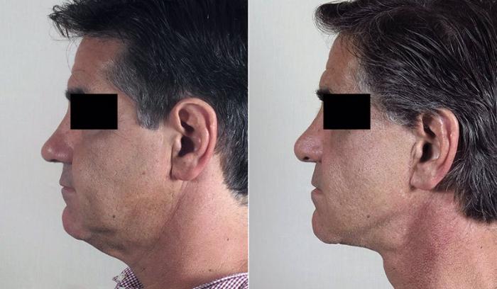 Facelift Case 34 Before & After View #2 | Paramus, New Jersey | Parker Center for Plastic Surgery
