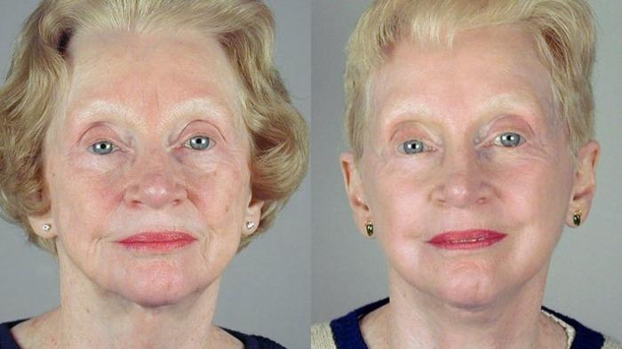 Facelift Case 35 Before & After View #1 | Paramus, New Jersey | Parker Center for Plastic Surgery