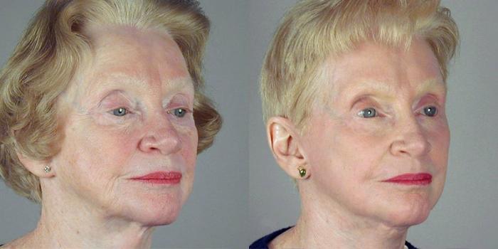 Facelift Case 35 Before & After View #2 | Paramus, New Jersey | Parker Center for Plastic Surgery