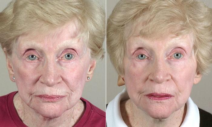 Facelift Case 35 Before & After View #3 | Paramus, New Jersey | Parker Center for Plastic Surgery