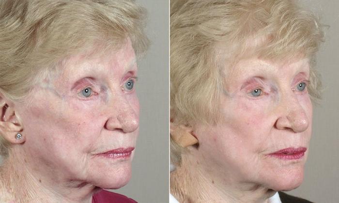 Facelift Case 35 Before & After View #4 | Paramus, New Jersey | Parker Center for Plastic Surgery