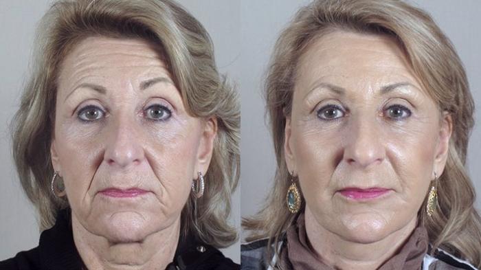 Facelift Case 36 Before & After View #1 | Paramus, New Jersey | Parker Center for Plastic Surgery