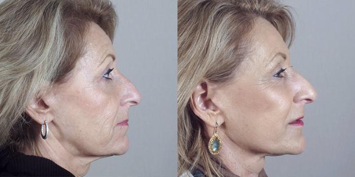 Facelift Case 36 Before & After View #2 | Paramus, New Jersey | Parker Center for Plastic Surgery