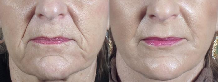 Facelift Case 36 Before & After View #3 | Paramus, New Jersey | Parker Center for Plastic Surgery