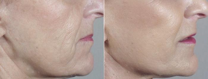 Facelift Case 36 Before & After View #4 | Paramus, New Jersey | Parker Center for Plastic Surgery