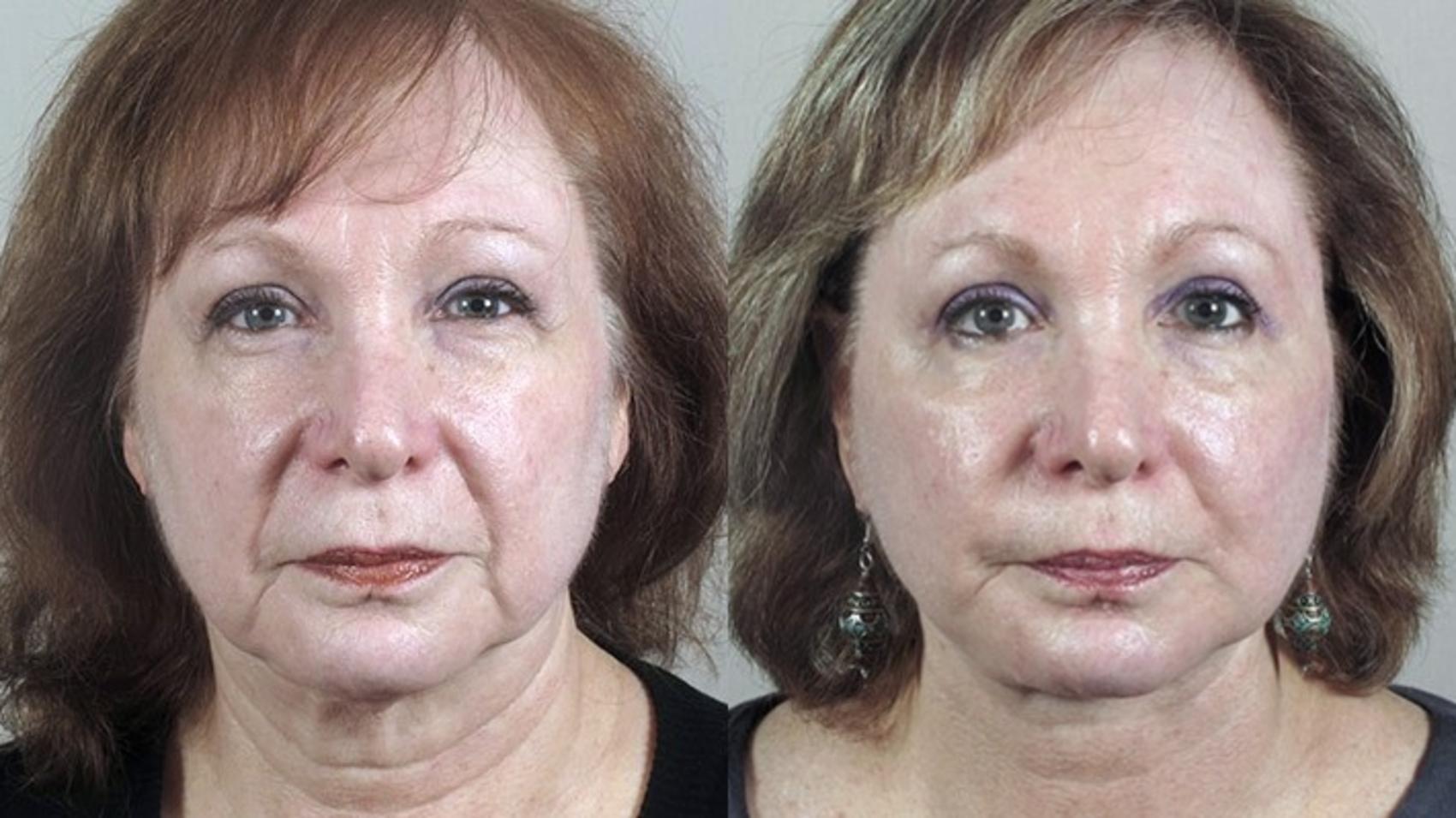 Facelift Case 39 Before & After View #1 | Paramus, New Jersey | Parker Center for Plastic Surgery