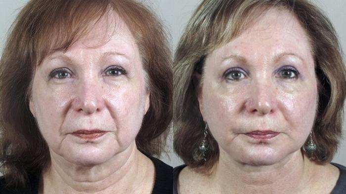 Facelift Case 39 Before & After View #1 | Paramus, New Jersey | Parker Center for Plastic Surgery