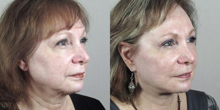 Facelift Case 39 Before & After View #2 | Paramus, New Jersey | Parker Center for Plastic Surgery