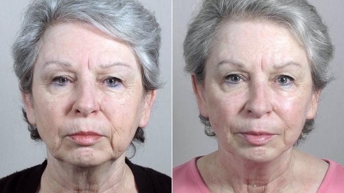 Facelift Case 40 Before & After View #1 | Paramus, New Jersey | Parker Center for Plastic Surgery