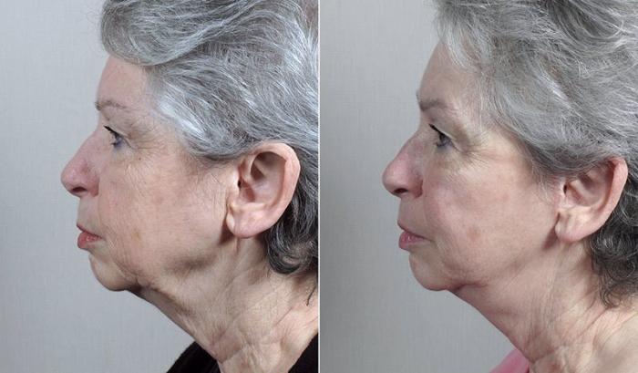Facelift Case 40 Before & After View #2 | Paramus, New Jersey | Parker Center for Plastic Surgery