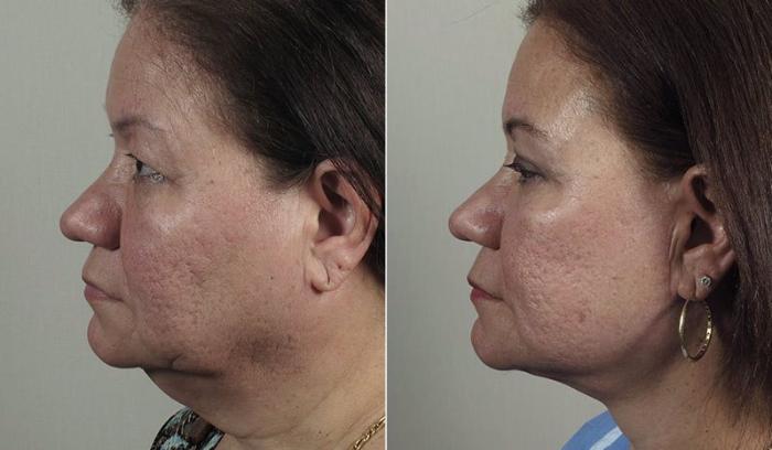 Facelift Case 41 Before & After View #2 | Paramus, New Jersey | Parker Center for Plastic Surgery