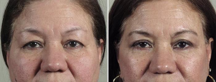 Facelift Case 41 Before & After View #3 | Paramus, New Jersey | Parker Center for Plastic Surgery