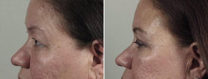 Facelift Case 41 Before & After View #4 | Paramus, New Jersey | Parker Center for Plastic Surgery