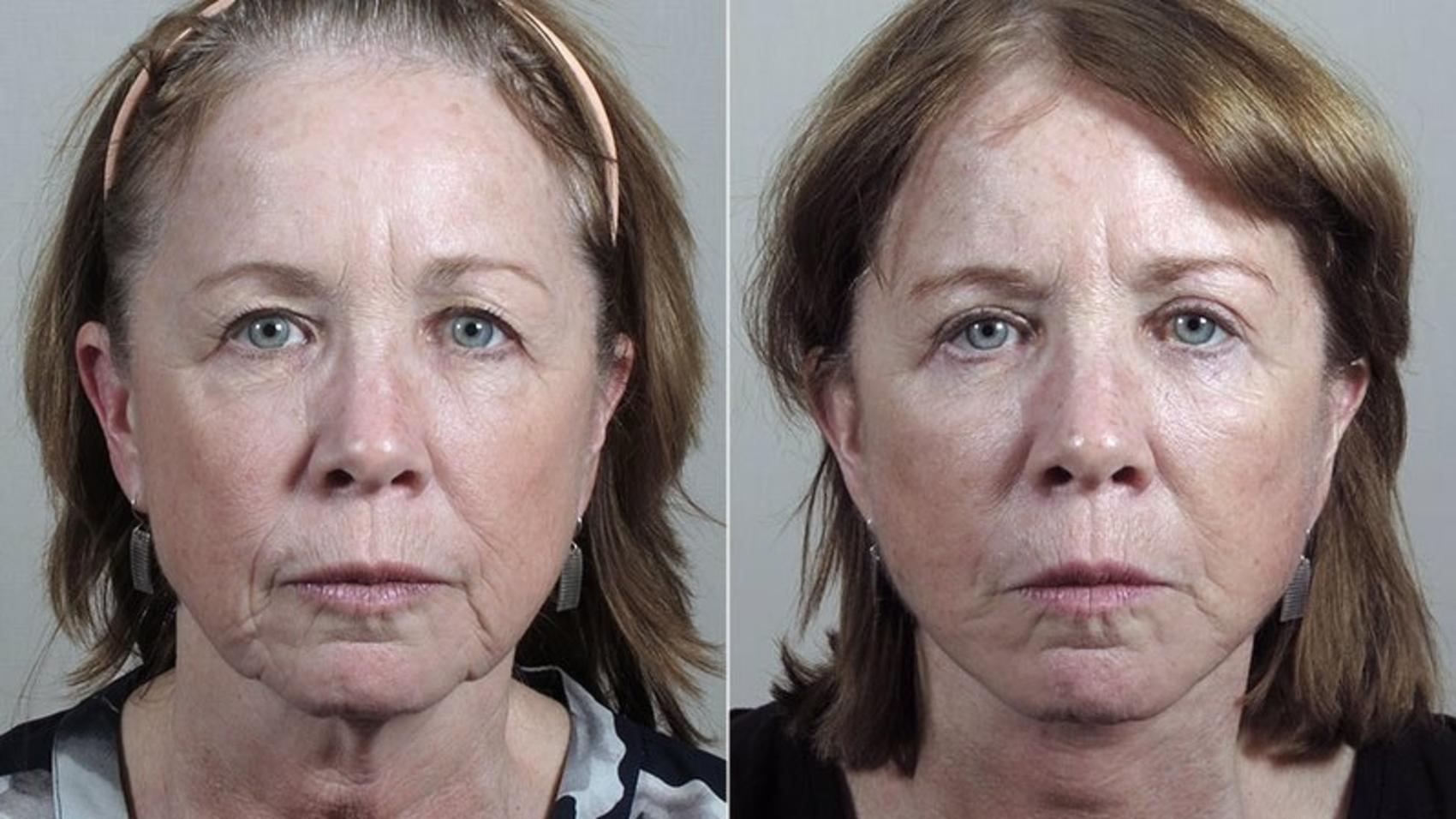 Facelift Case 42 Before & After View #1 | Paramus, New Jersey | Parker Center for Plastic Surgery