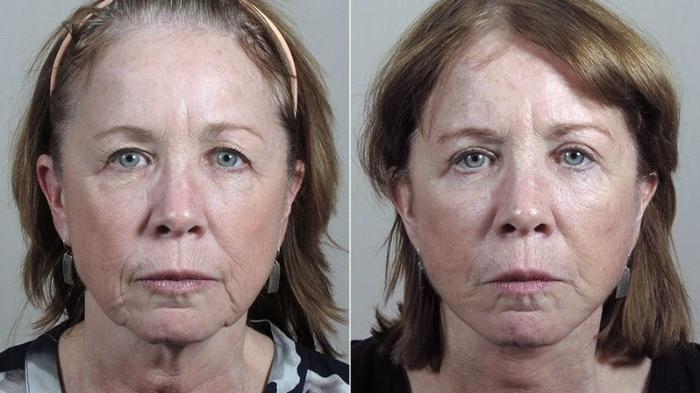 Facelift Case 42 Before & After View #1 | Paramus, New Jersey | Parker Center for Plastic Surgery