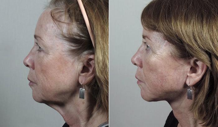 Facelift Case 42 Before & After View #2 | Paramus, New Jersey | Parker Center for Plastic Surgery