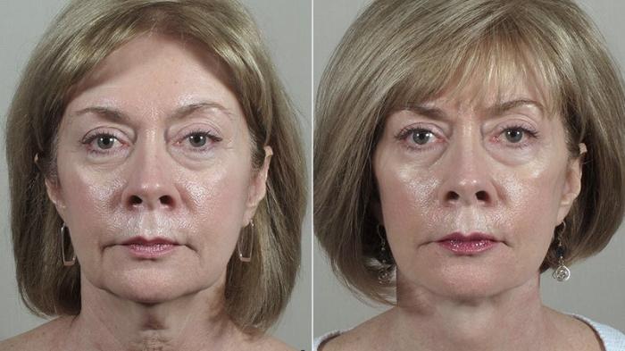 Facelift Case 43 Before & After View #1 | Paramus, New Jersey | Parker Center for Plastic Surgery