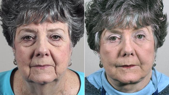 Facelift Case 44 Before & After View #1 | Paramus, New Jersey | Parker Center for Plastic Surgery
