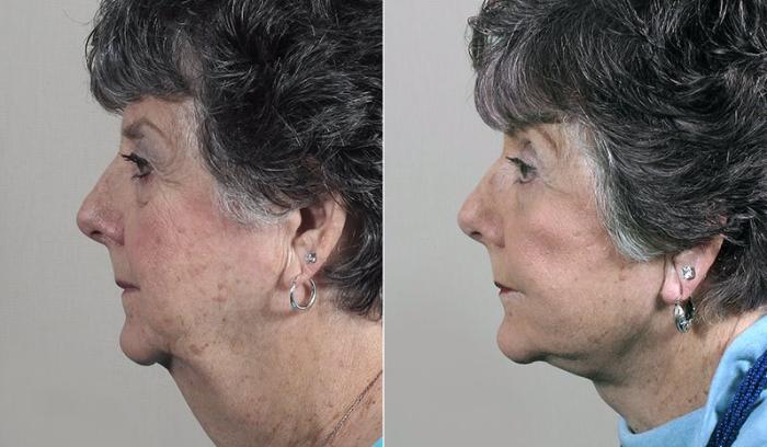 Facelift Case 44 Before & After View #2 | Paramus, New Jersey | Parker Center for Plastic Surgery