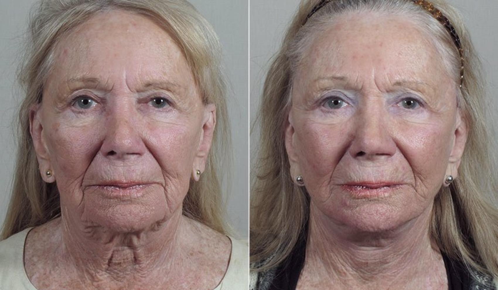 Facelift Case 45 Before & After View #1 | Paramus, New Jersey | Parker Center for Plastic Surgery