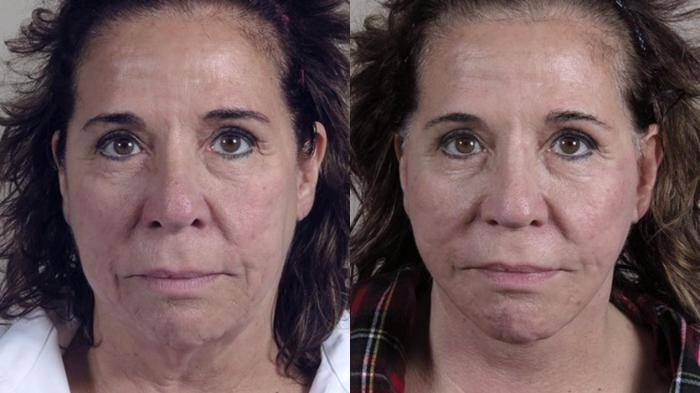Facelift Case 46 Before & After View #2 | Paramus, New Jersey | Parker Center for Plastic Surgery