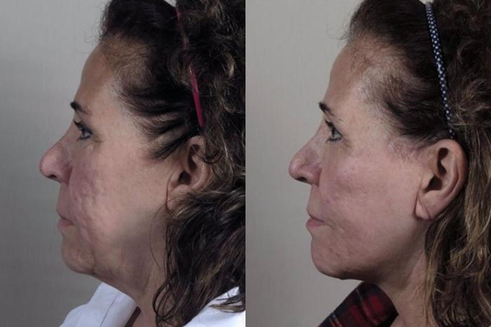 Facelift Case 46 Before & After View #3 | Paramus, New Jersey | Parker Center for Plastic Surgery